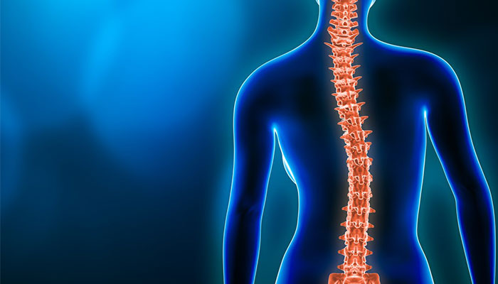 An image of a spine that is curved from scoliosis
